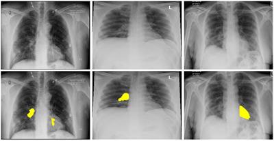 Exploring transfer learning in chest radiographic images within the interplay between COVID-19 and diabetes